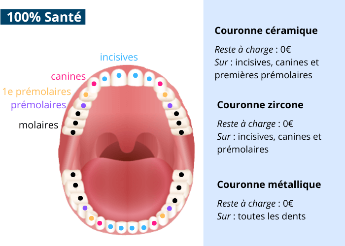 Couronne dentaire - 100% Santé