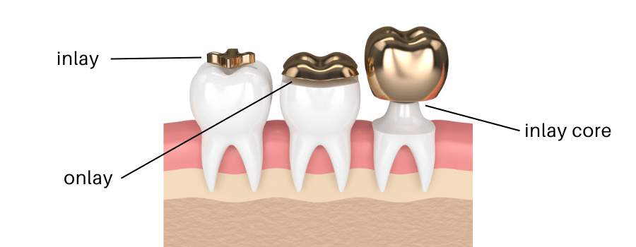 différence inlay onlay et inlay core