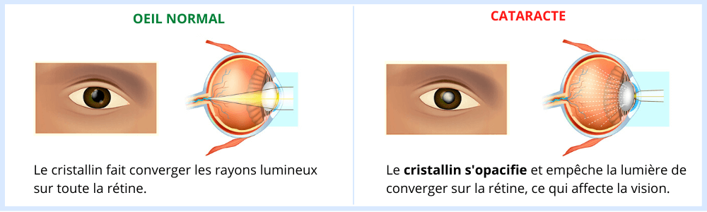 cataracte explications
