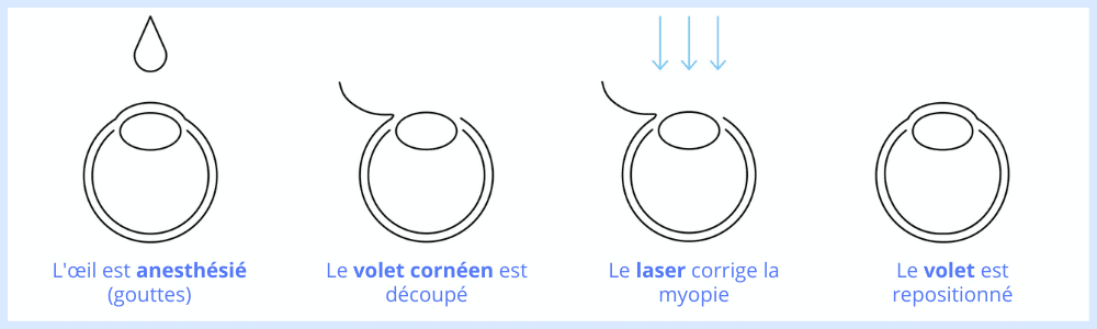 déroulement opération myopie