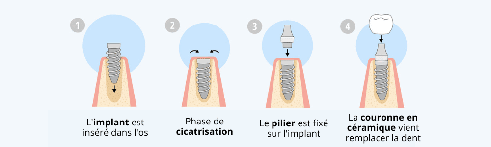 pose d'un implant dentaire