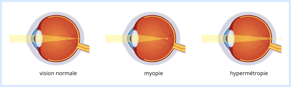 myopie explications