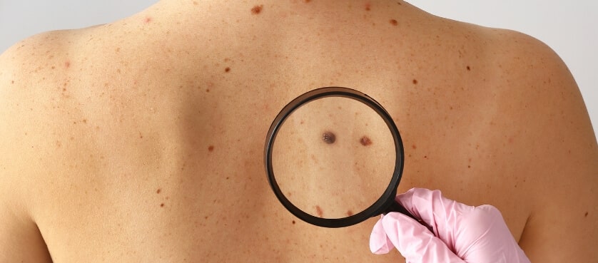 surveillance grain de beauté